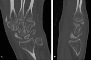 TC de muñeca izquierda. A. Imagen coronal con escafoides de pequeño tamaño, multifragmentado y escleroso. B. Imagen sagital en la que se aprecia desviación hacia dorsal del semilunar con escafoides multifragmentado, de pequeño tamaño e hiperatenuado.