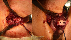 Vía de Boyd Anderson modificada por Morrey. A)El tendón es transportado atravesando la membrana interósea. B)Labrado de zona de inserción en la tuberosidad bicipital y túneles transóseos.