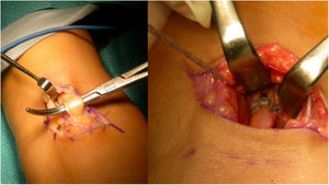 Vía anterior de Henry. A)Obsérvese la disección y obtención del tendón. B)El tendón es reinsertado mediante un botón cortical.