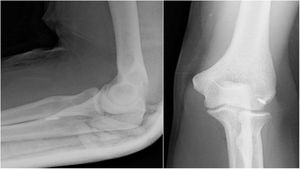 Controles radiográficos. A)Botón cortical tras reconstrucción mediante vía anterior. B)Reconstrucción mediante doble abordaje. Reconstrucción con anclaje en localización epicondilar que obligó a la retirada del mismo y a una nueva intervención.
