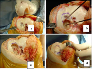 Lesión osteocondral y su aloinjerto (a). Procedimiento quirúrgico, mediante 2 aloinjertos encastrados (b y c). Resultado final (d).