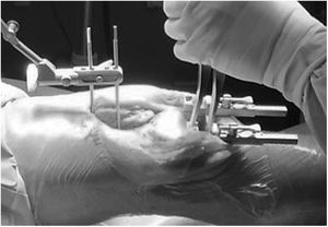 Tensionado manual en extensión de los ligamentos según la técnica GP.