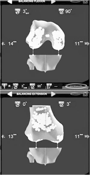 Balance ligamentoso en flexión y extensión realizado con navegación. Mediante la liberación de las partes blandas debe perseguirse un «gap» femorotibial simétrico medial-lateral y en flexión-extensión.