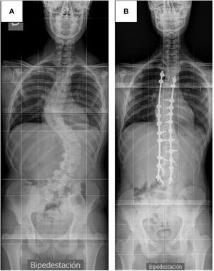 Paciente 2. A) Radiografía posteroanterior preoperatoria. B) Radiografía posteroanterior postoperatoria.