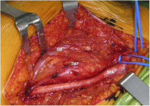 Foto quirúrgica TMF ingle derecha. SFA: arteria femoral superficial; SM: músculo sartorio; TMF: tumor mesenquimal fosfatúrico englobando parcialmente a la vena femoral superficial (en plano profundo).