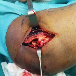 (color). Abordaje lateral, obsérvese la importante afectación de partes blandas con desgarro de la musculatura, afectación del CLL y rotura capsular con exposición directa de la articulación radiocapitelar. CLL: complejo ligamentoso lateral.