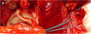 Inspección acetabular y sutura labral. A) La inspección acetabular permite observar el estado del cartílago acetabular y el desprendimiento labral. B) El labrum se repara con suturas de anclaje óseo extraarticular.