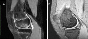 A) Osteocondritis disecante (Dipaola grado II), imagen de RNM preoperatoria. B) Consolidación ósea en RNM postoperatoria a los 5 años.
