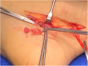 Imagen intraoperatoria: resección de lesión quística que se envía a biopsia.
