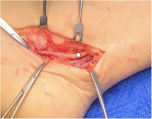 Imagen intraoperatoria: se aprecia NTP (punto blanco) liberado sin adherencias perineurales.