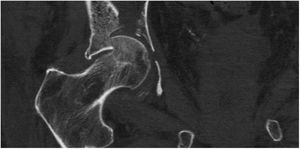 Fractura parcelar de la cabeza femoral con hundimiento del techo acetabular.