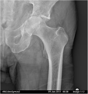 Fractura con protrusión medial de la cabeza femoral, hundimiento del techo acetabular, fractura de la lámina cuadrilátera y pared anterior.