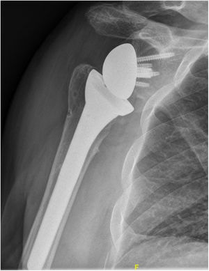 Imagen radiográfica de notching escapular donde se aprecia la erosión en el cuello de la glena producida por el choque contra el componente humeral.