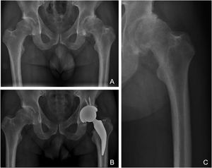 Radiografías de un paciente masculino de 38 años con diagnóstico de artrosis avanzada de su cadera izquierda y fue sometido a RTC. A) Radiografía AP preoperatoria donde se observa una falta de cobertura de ambas caderas, con desgaste severo de su cadera izquierda y corticales femorales gruesas que podrían corresponder a la clasificación «A» de Dorr. B) Radiografía AP postoperatoria inmediata donde se puede observar un RTC izquierdo con restauración de la biomecánica de su cadera, nótese que el vástago corto no invade el canal femoral a nivel diafisaria, evitando conflictos de incompetencia fémur-implante. C) Radiografía focalizada del fémur izquierdo preoperatorio donde se observa con más detalle el potencial conflicto para colocar un vástago estándar no cementado en un fémur Dorr A.