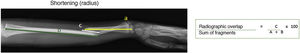 Profile X-ray of a left forearm with diaphyseal fracture of both bones. (A) Measurement of the distal fragment length. (B) Measurement of the proximal fragment length. (C) Measurement of the overlap length of fragments A and B. The percentage ratio between the length of C over the sum of A and B must be made. If the result for the radius bone is greater than 5%, we consider that the patient would have a 39% higher risk of requiring open surgery.