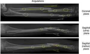 Profile X-rays, 1 anteroposterior and 2 of a left forearm with diaphyseal fractures of both bones. The fragment angulations should be measured tracing the longitudinal axis of each proximal fragment and by measuring the angle from measurements of the longitudinal axis according to its corresponding distal fragment.