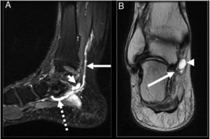 Image A: sagittal T2 FS slice where ganglion is observed (arrow head) with venous vessel pre-obstruction (dotted arrow) and post-obstruction (continuous arrow). Image B: coronal dp slice: ganglion in tunnel (arrow head) and tibial nerve branches (continuous arrow).