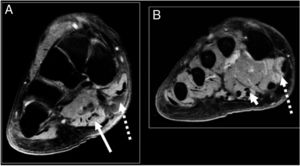 Image A: Coronal T2 FS slice where hallux abductor denervation oedema is observed (discontinuous arrow) and flexor cari radialis brevis (continuous arrow). Image B: coronal T2 FS slice: hallux abductor denervation oedema (discontinuous arrow) and first lumbrical (arrow head).