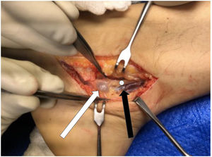 Intraoperative image: cystic lesion observed (white arrow) more varicose veins (black arrow) in relation to PTN (white dot).