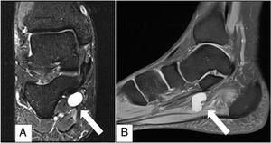 Coronal (A) and sagittal (B) slice of RM where a new rounded cystic lesion was observed (continuous arrow).