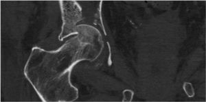 Parcel fracture of femoral head with acetabular roof collapse.