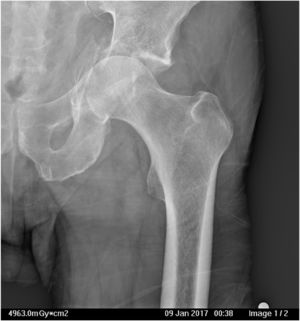 Fracture with medial protrusion of the femoral head, collapse of acetabular roof, fracture of quadrilateral lamina and anterior wall.
