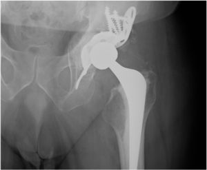 Incorporation of autologous grafts at 6 months follow up.