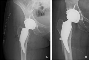 The image shows a woman aged 32 years who underwent a THA for osteonecrosis of the right hip. A) Postoperative X-ray of the same patient with THR with cortical fracture of intraoperative lateral femoral cortex treated during surgery with monofilament twisted wire cerclage. B) AP X-ray showing a well-fixed stem with no subsidence and a consolidated lateral femoral cortex and good fixation at six months follow-up.
