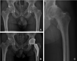X-rays of a 38-year-old male patient with diagnosis of advanced osteoarthritis of the left hip and who underwent THR. A) Preoperative AP X-ray where a lack of coverage of both hips is observed, with severe wear of his left hip and thick femoral cortices that could correspond to Dorr “A” classification. B) Immediate postoperative AP X-ray where a left THR is observed with restoration of his hip biomechanics; note the short stem does not invade the femoral canal at diaphyseal level, avoiding conflicts of femur-implant incompetence. C) X-ray focused on left preoperative hip where the potential conflict for implanting a cementless standard stem in a Dorr A femur is observed in greater detail.