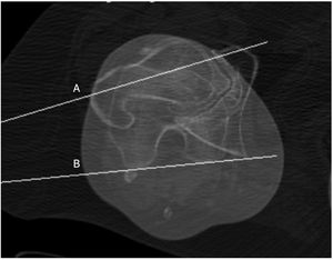 Medición de la version femoral en TAC según el método descrito por Murphy et al.22,23. El ángulo formado entre A, (eje del cuello femoral) y B (eje posterior de los cóndilos femorales) representa la versión femoral.