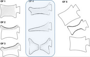 Clasificación de fracturas vertebrales osteoporóticas propuestas por la DGOU8.