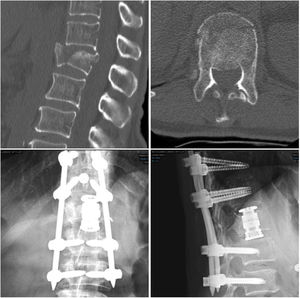 Mujer de 68 años con fractura de L1 tras caída de su propia altura. Se decide fijación percutánea T12-L2 y corpectomía retropleural con sustituto vertebral. Imagen de TC en cortes sagital y axial prequirúrgicos. Resultado radiográfico con proyecciones anteroposterior y lateral a los tres meses postquirúrgicos.