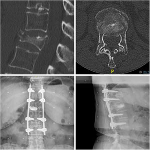 Mujer de 67 años con fractura L1 tras caída de su propia altura. Se decide fijación percutánea T12-L2 y vertebroplastia percutánea. Imagen de TC en cortes sagital y axial prequirúrgicos. Resultado radiográfico con proyecciones anteroposterior y lateral a los tres meses postquirúrgicos.