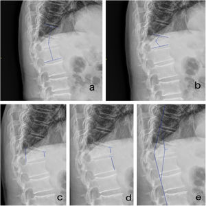Mediciones radiológicas utilizadas: a) ángulo fractuario, b) deformidad cifótica, c) porcentaje de compresión (Í. de Berg), d) porcentaje de acuñamiento y e) ángulo de deformación.