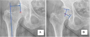 A. Radiographic calculation of femoral offset in the healthy hip. B. Radiographic determination of the centre of rotation of the femoral head.