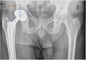 Radiographic calculation of femoral offset in the operated hip.