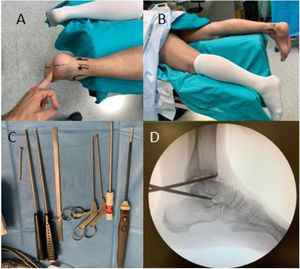 Intraoperative images of the posterior arthroscopic technique. (A and B) Prone position of the patient with the ankle protruding distally to the operating table and on a soft support and anatomical references for posterior arthroscopic portals. (C) Arthroscopic instruments used with 4.5mm arthroscope with 30. (D) Intraoperative lateral X-ray showing excellent access to the tibiotalar and subtalar joints.