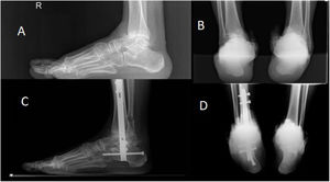 Pre-surgery and 3 months after surgery radiographs showing tibiotalar consolidation. (A) Pre-surgery lateral radiograph. (B) Pre-surgery Saltzman projection X-ray. (C) Lateral X-ray 3 months after surgery. (D) Saltzman's X-ray 3 months postoperatively.