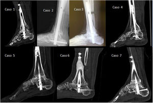 Imaging tests of all cases at one to one and a half years post-surgery. In cases 2 and 3 only the lateral radiographs are shown as CT scans were not available; in the remaining cases, the longitudinal slices of the CT scans are shown to confirm the consolidation or absence of consolidation of the tibiotalar and subtalar joint.