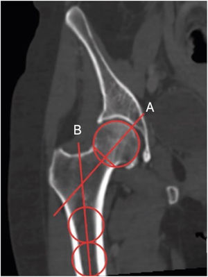 Measurement of the CCD, as described by Boese et al.24 The angle formed between A (head-neck axis) and B (femoral shaft axis) represents CCD.
