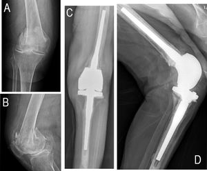 A y B) Imágenes radiográficas anteroposterior y lateral que reflejan la fractura femoral supraintercondílea (tipo 33-C3 de la clasificación AO/OTA). C y D) Imágenes radiográficas postoperatorias anteroposterior y lateral que muestran la implantación correcta de la artroplastia.