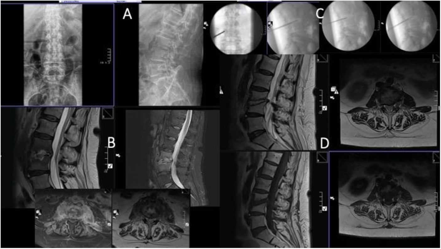 [Translated article] Analysis of results of open and percutaneous disc ...