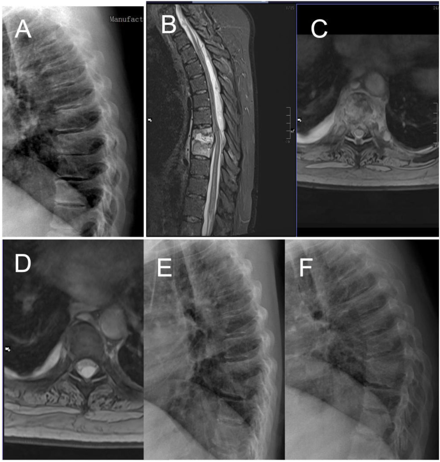 [Translated article] Analysis of results of open and percutaneous disc ...
