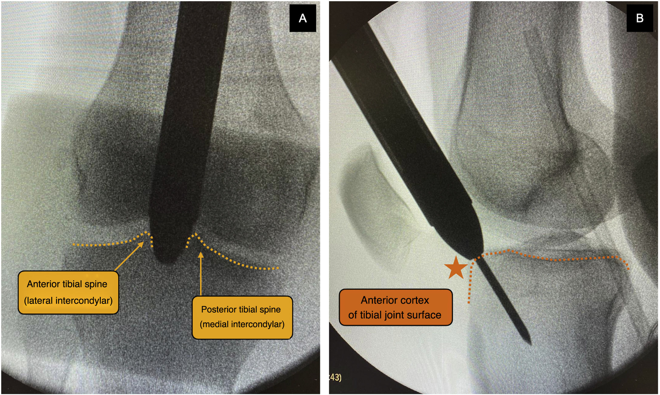 5/1/2019 1 Proximal Tibia Nailing: Tips and Tricks Proximal tibia nailing:  Why not plate? Evidence for Nailing