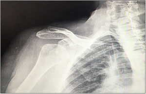 Luxación inveterada de hombro como indicación de artroplastia inversa.