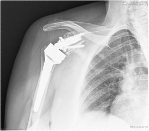 Radiografía de artroplastia inversa de hombro con autoinjerto acoplado con dos tornillos canulados en el postoperatorio inmediato.