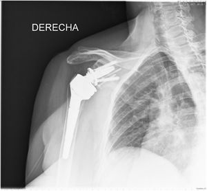 Radiografía de artroplastia inversa de hombro con autoinjerto acoplado con dos tornillos canulados a los 3años de la cirugía.