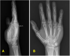 Proyección lateral (A) y anteroposterior (B) con la medición realizada del ángulo del foco de fractura en la primera.