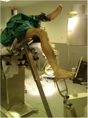 Imágenes intraoperatorias de la colocación de un paciente para intervención mediante abordaje IP, en mesa radiolucente y con tracción transcalcánea con la rodilla a unos 100-120° de flexión.