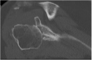 Coronal CT section of glenoid defect for preoperative study.